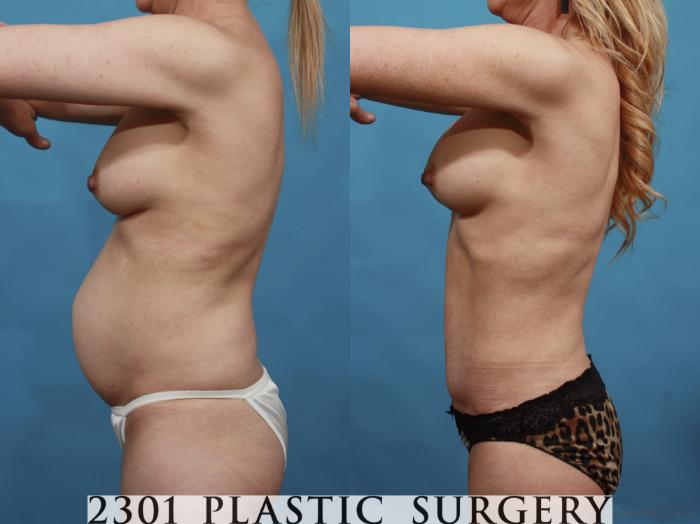 Before & After Silicone Implants Case 600 View #4 View in Fort Worth, Plano, & Frisco, Texas