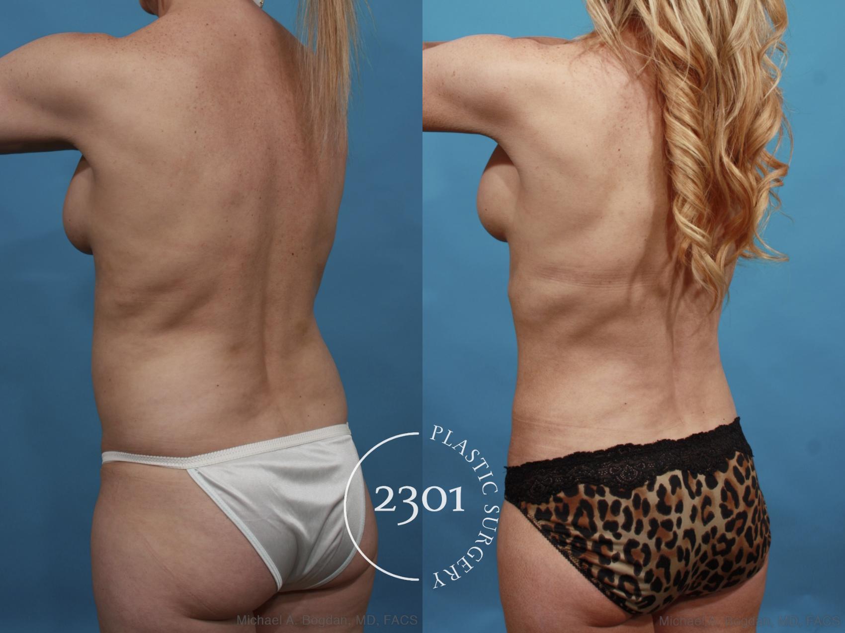 Before & After Breast Augmentation Revision Case 600 View #5 View in Fort Worth, Plano, & Frisco, Texas
