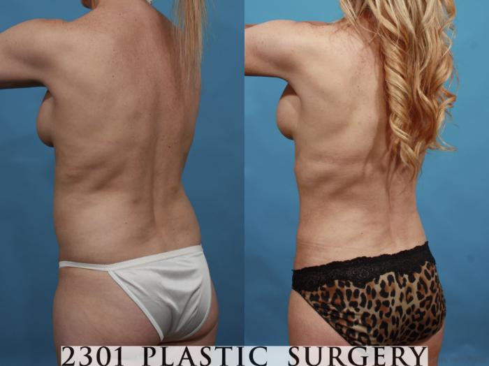 Before & After Silicone Implants Case 600 View #5 View in Fort Worth, Plano, & Frisco, Texas