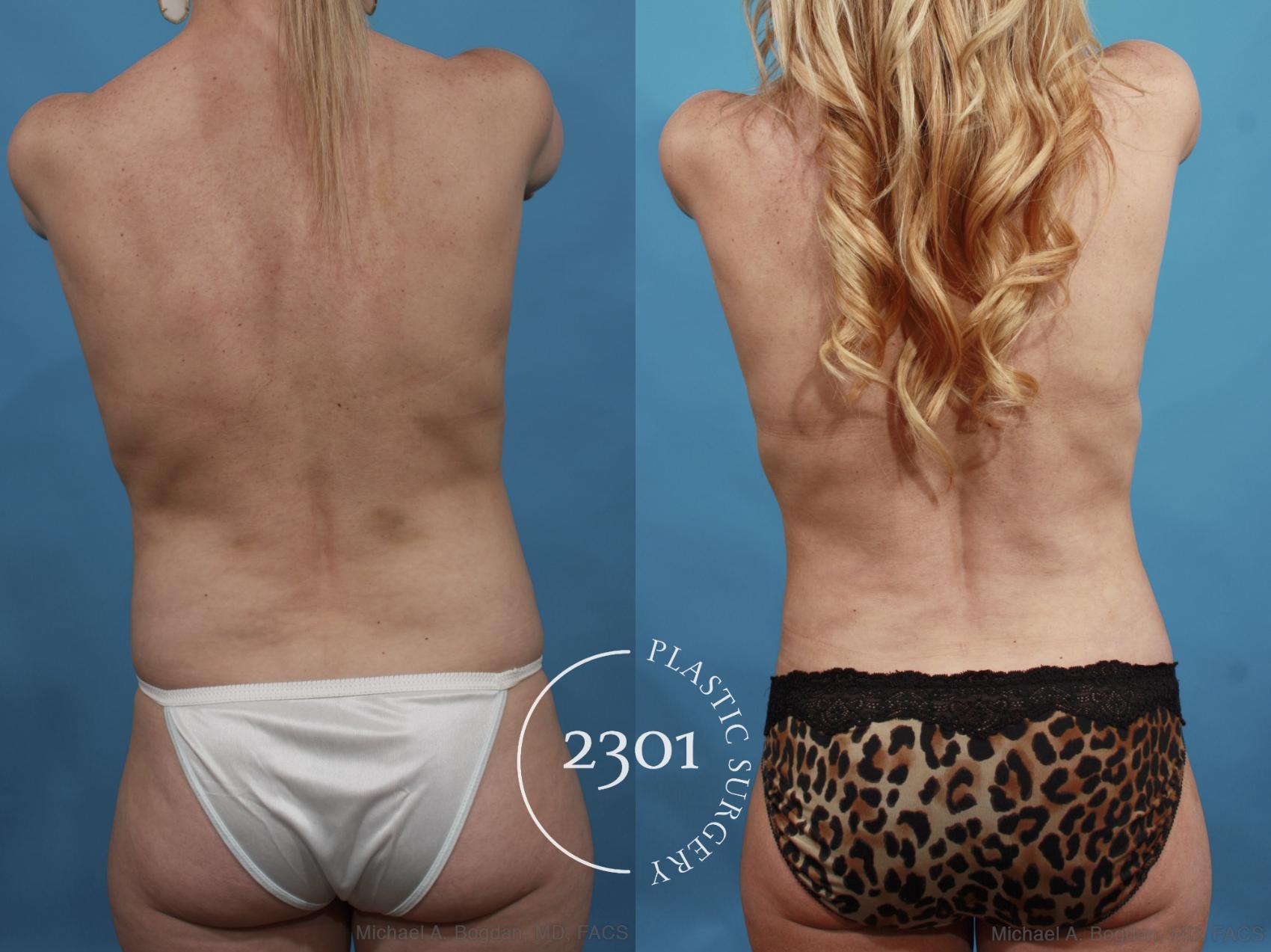 Before & After Breast Augmentation Revision Case 600 View #6 View in Fort Worth, Plano, & Frisco, Texas