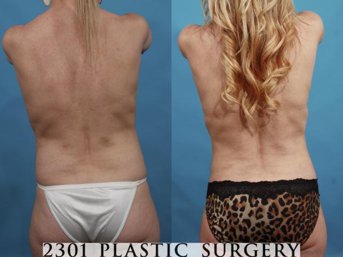 Before & After Silicone Implants Case 600 View #6 View in Fort Worth, Plano, & Frisco, Texas