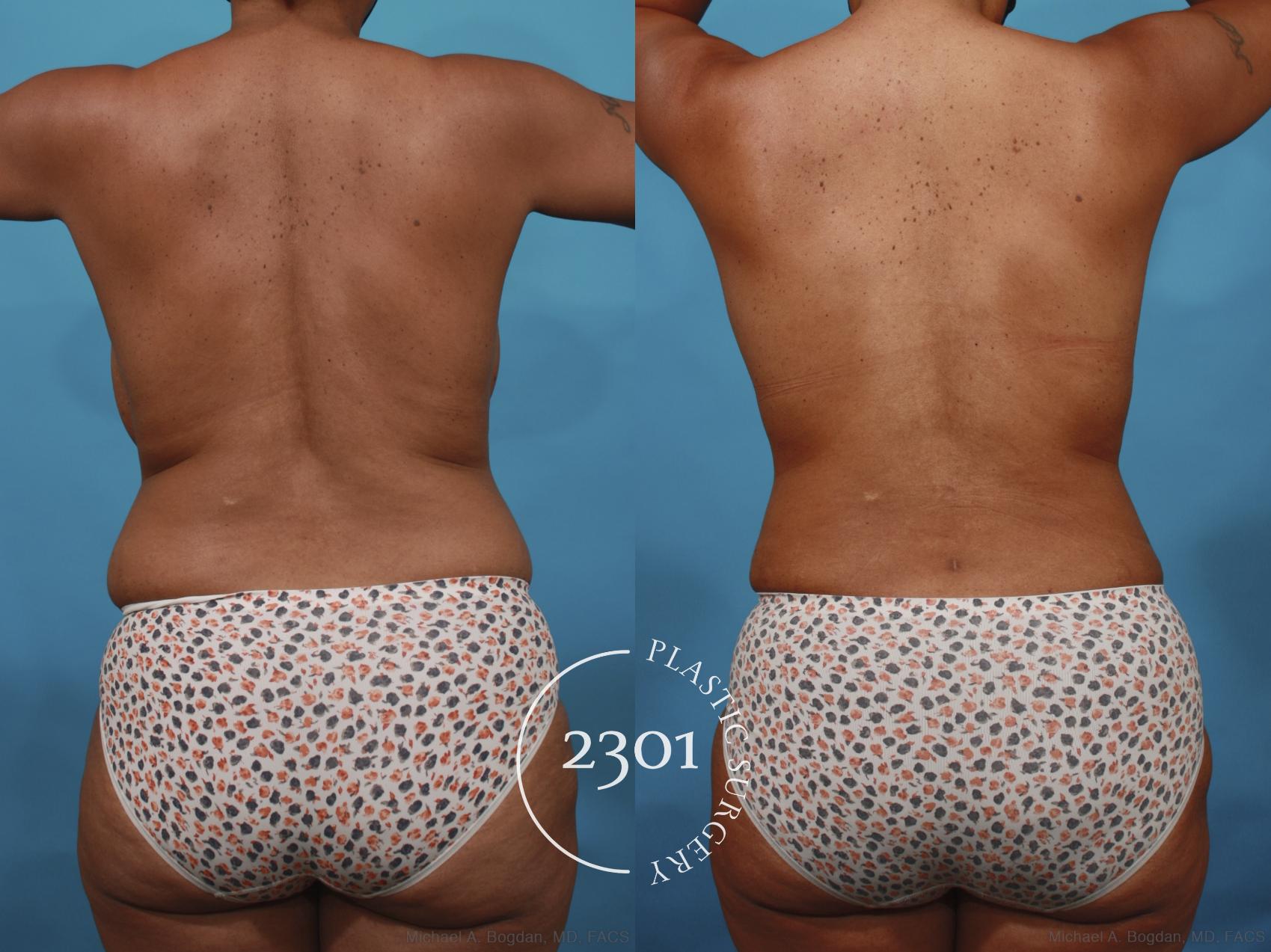 Before & After Mommy Makeover Case 657 Back View in Fort Worth, Plano, & Frisco, Texas