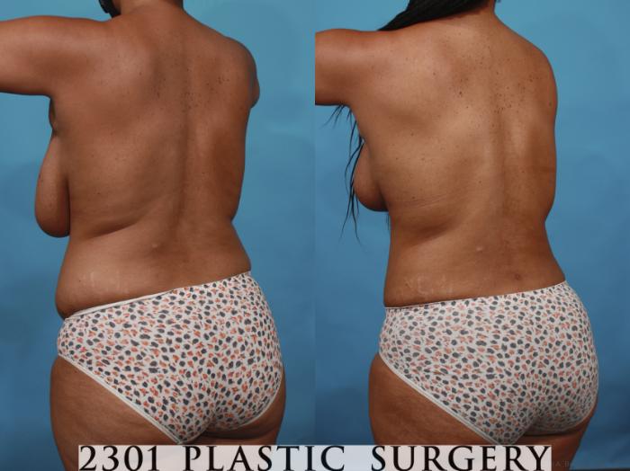Before & After Mommy Makeover Case 657 Back Left Oblique View in Fort Worth, Plano, & Frisco, Texas