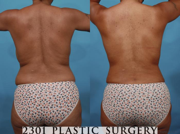 Before & After Mommy Makeover Case 657 Back View in Fort Worth, Plano, & Frisco, Texas