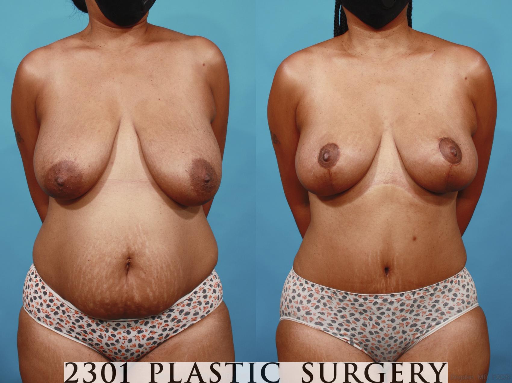 Before & After Mommy Makeover Case 657 Front View in Fort Worth, Plano, & Frisco, Texas