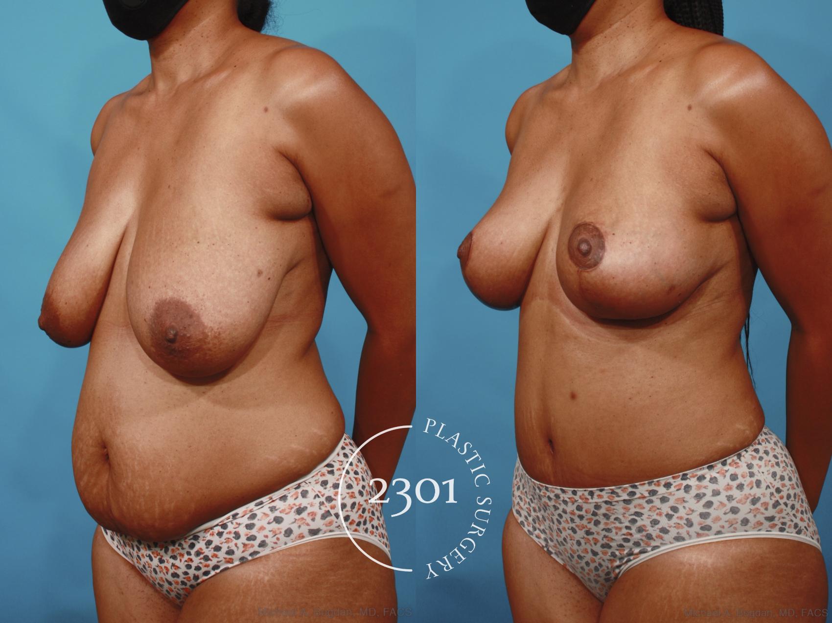 Before & After Mommy Makeover Case 657 Left Oblique View in Fort Worth, Plano, & Frisco, Texas