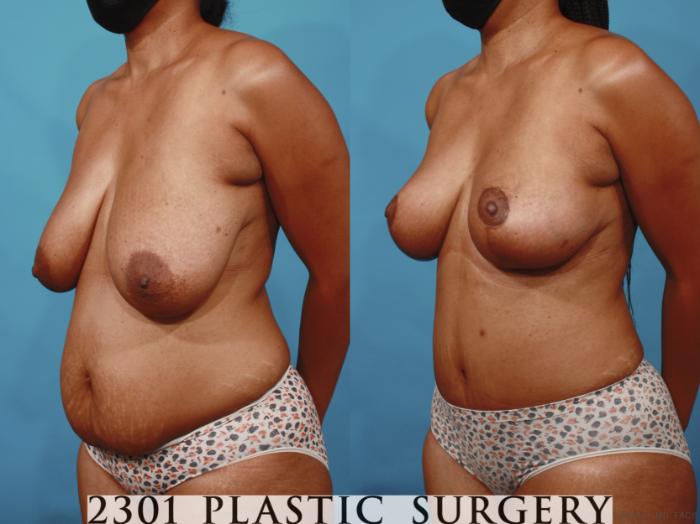 Before & After Mommy Makeover Case 657 Left Oblique View in Fort Worth, Plano, & Frisco, Texas