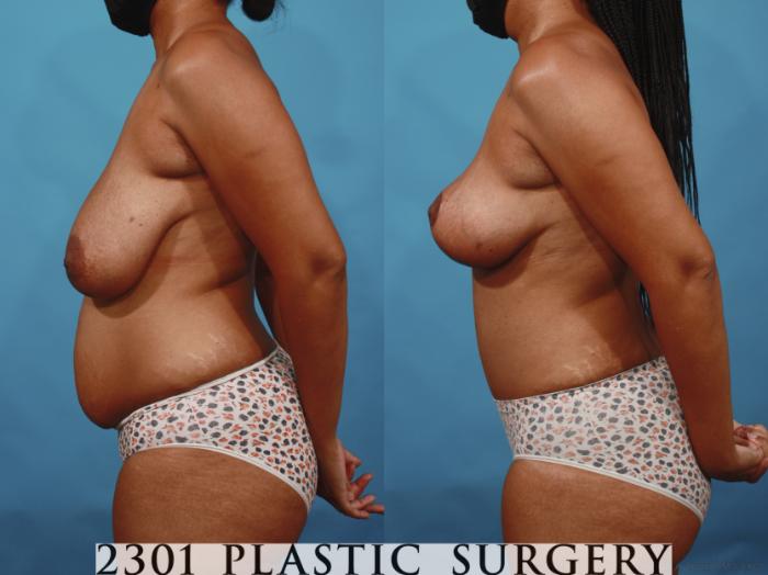 Before & After Mommy Makeover Case 657 Left Side View in Fort Worth, Plano, & Frisco, Texas