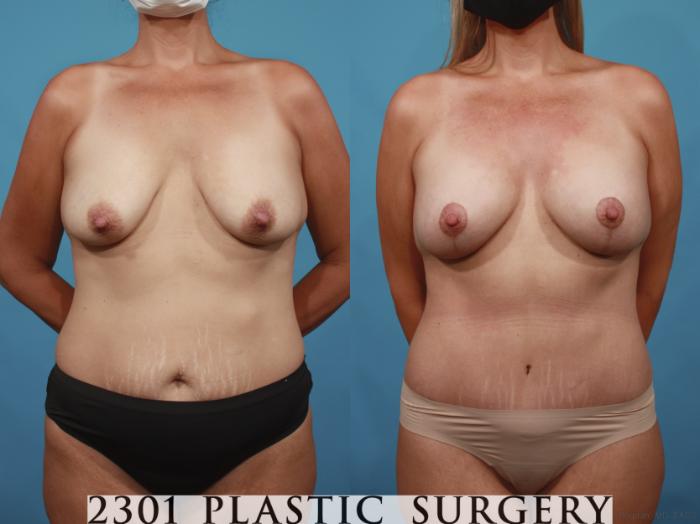 Before & After Tummy Tuck Case 658 Front View in Fort Worth, Plano, & Frisco, Texas