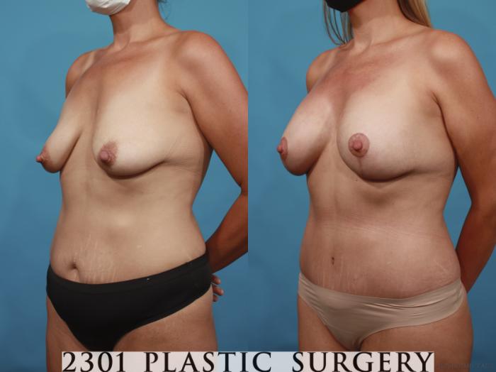 Before & After Tummy Tuck Case 658 Left Oblique View in Fort Worth, Plano, & Frisco, Texas