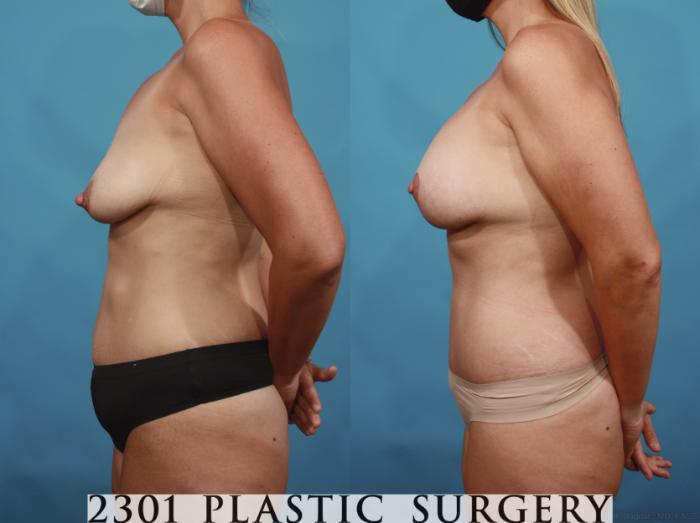 Before & After Tummy Tuck Case 658 Left Side View in Fort Worth, Plano, & Frisco, Texas