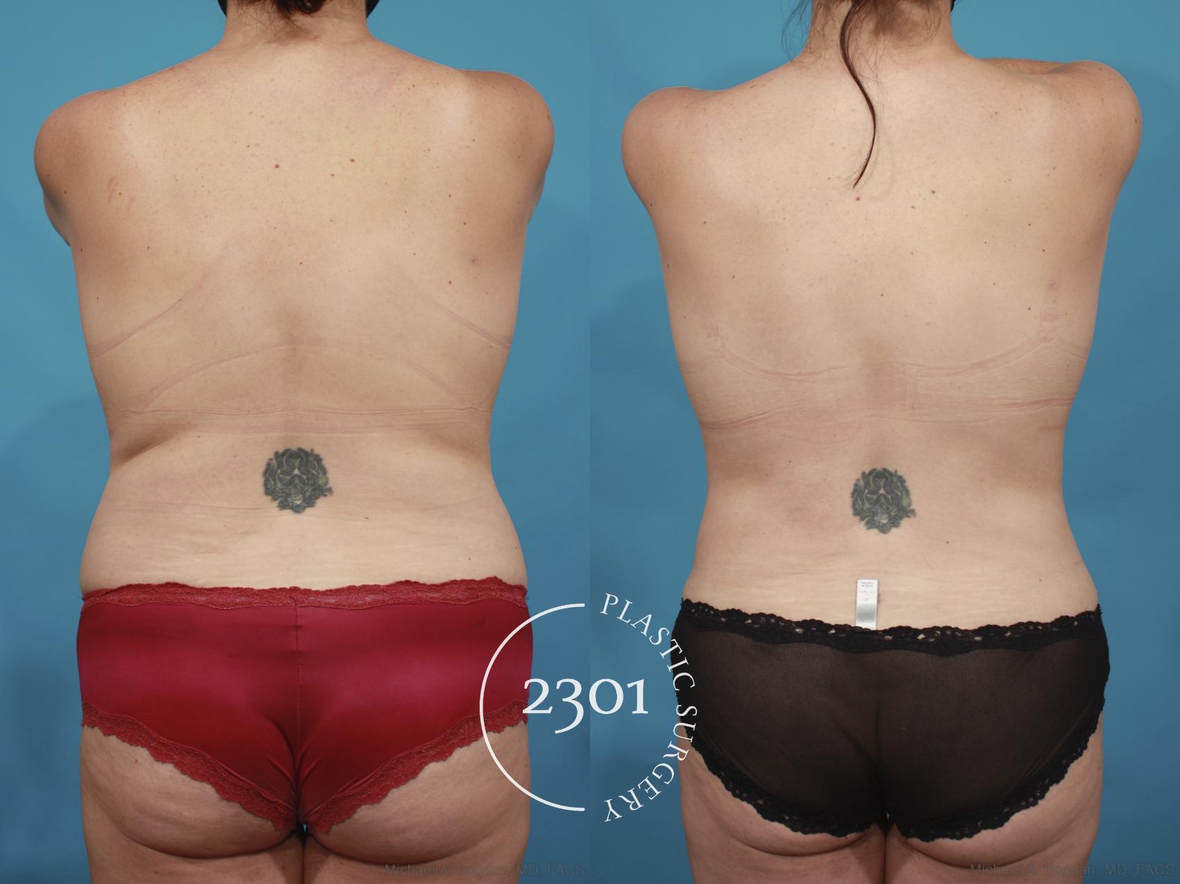 Before & After Mommy Makeover Case 659 Back View in Fort Worth, Plano, & Frisco, Texas