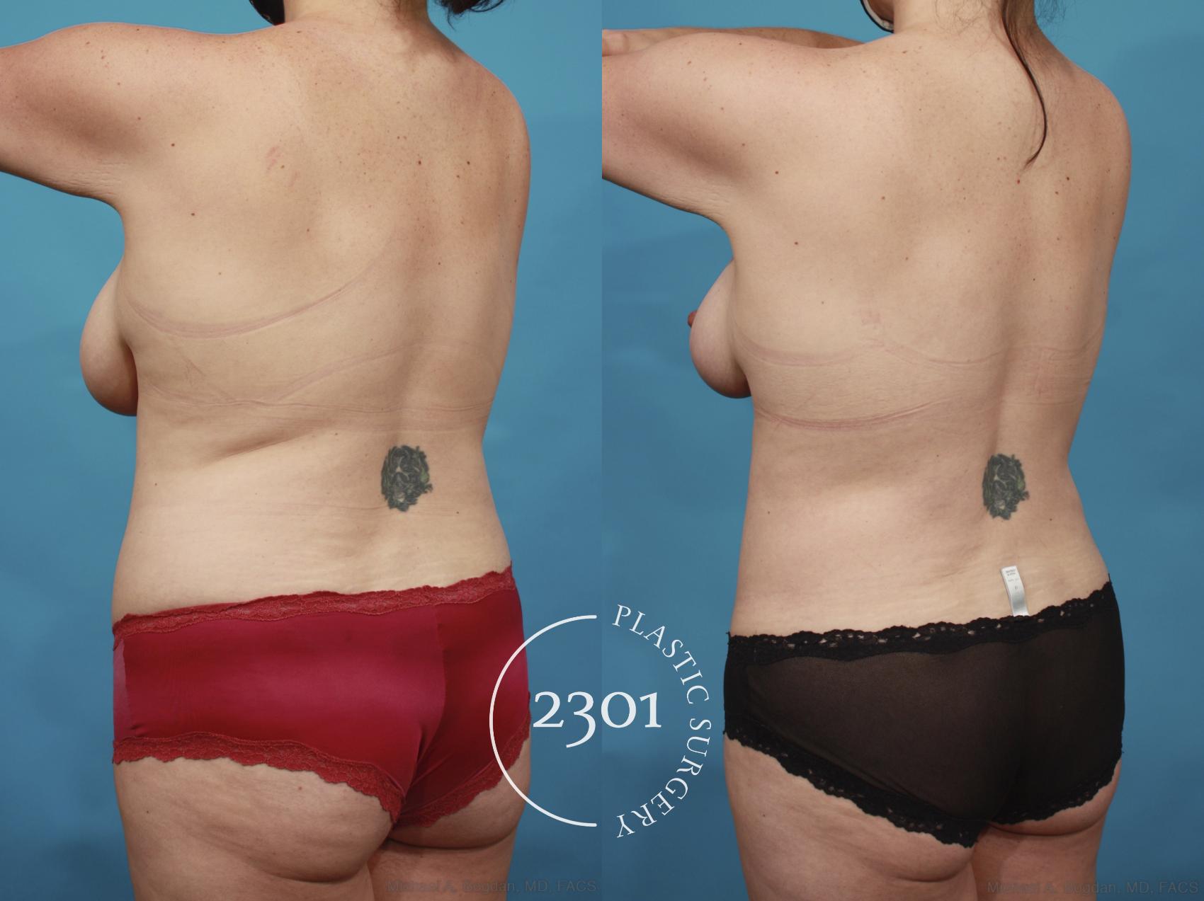 Before & After Mommy Makeover Case 659 Back Left Oblique View in Fort Worth, Plano, & Frisco, Texas