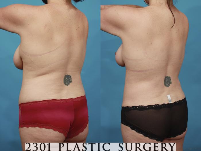 Before & After Breast Lift (Mastopexy) Case 659 Back Left Oblique View in Fort Worth, Plano, & Frisco, Texas