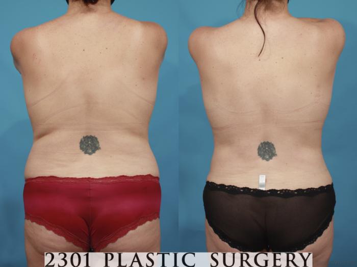 Before & After Mommy Makeover Case 659 Back View in Fort Worth, Plano, & Frisco, Texas