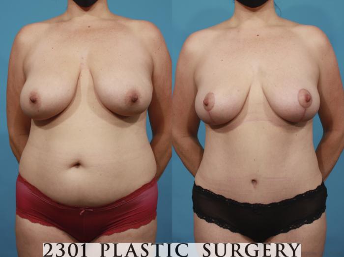 Before & After Breast Lift (Mastopexy) Case 659 Front View in Fort Worth, Plano, & Frisco, Texas