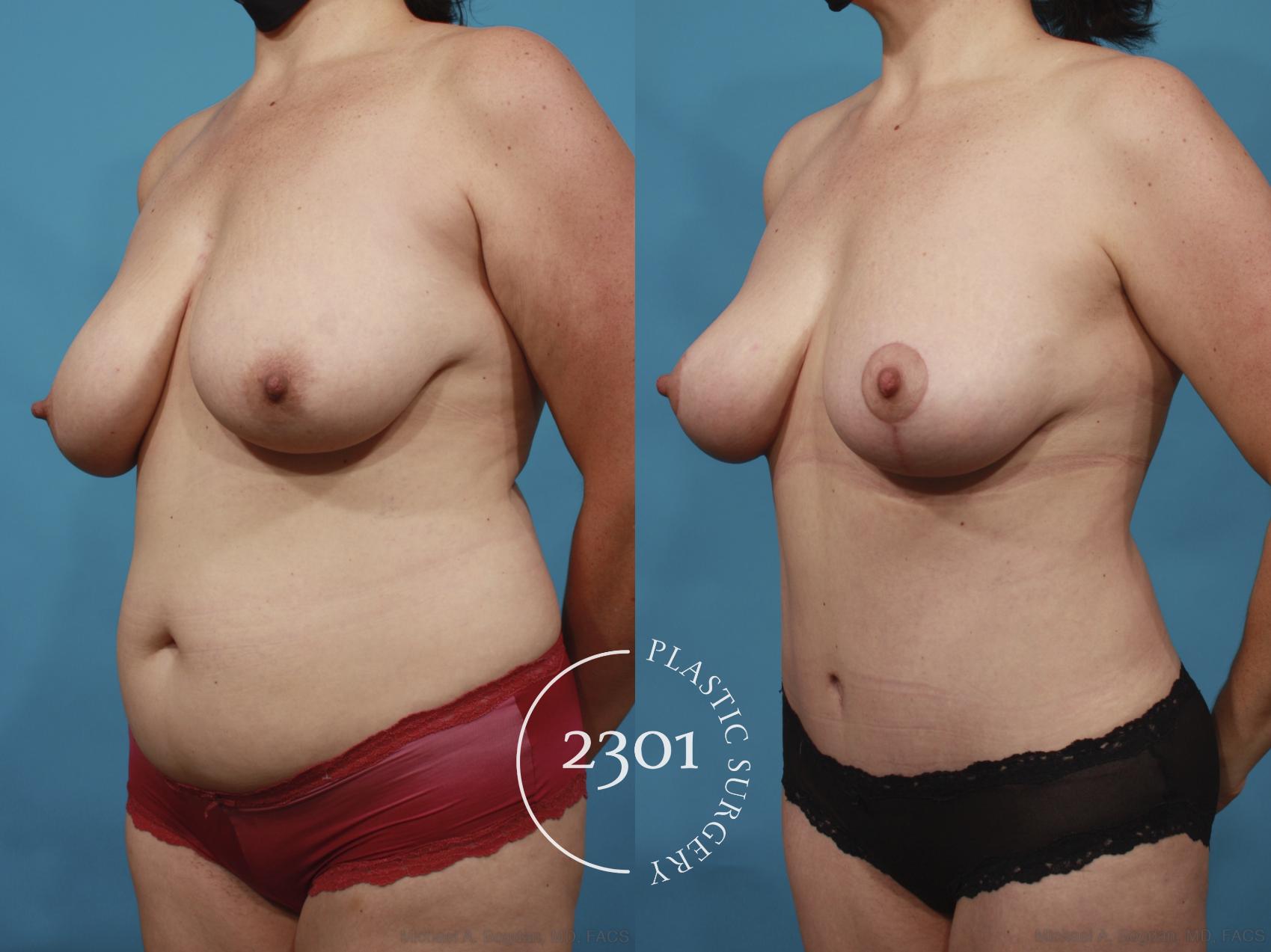 Before & After Mommy Makeover Case 659 Left Oblique View in Fort Worth, Plano, & Frisco, Texas
