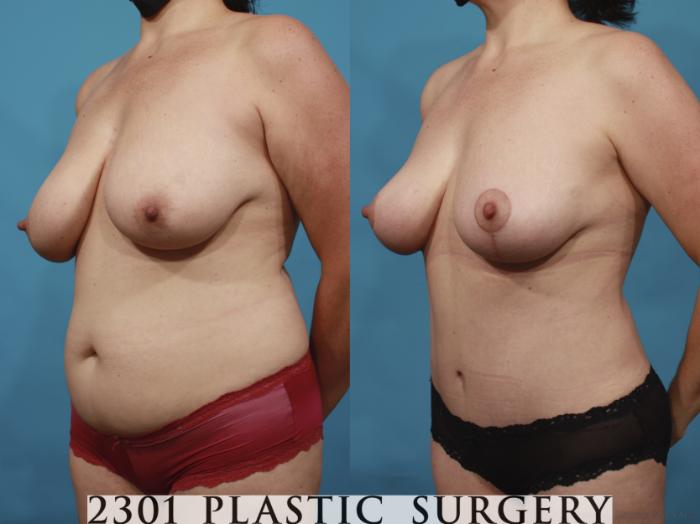 Before & After Breast Lift (Mastopexy) Case 659 Left Oblique View in Fort Worth, Plano, & Frisco, Texas
