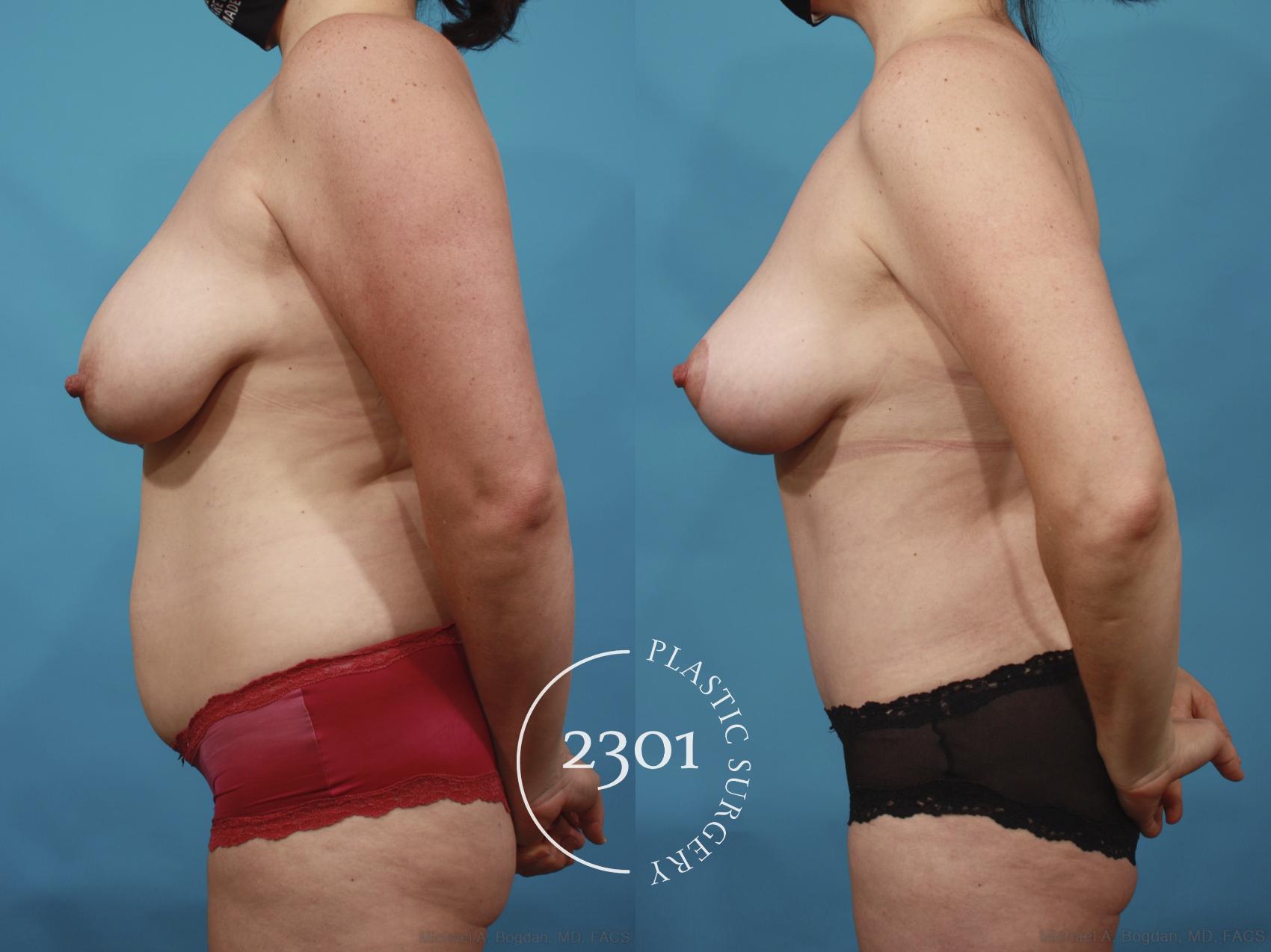 Before & After Mommy Makeover Case 659 Left Side View in Fort Worth, Plano, & Frisco, Texas