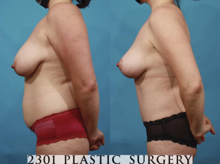 Before & After Breast Lift (Mastopexy) Case 659 Left Side View in Fort Worth, Plano, & Frisco, Texas