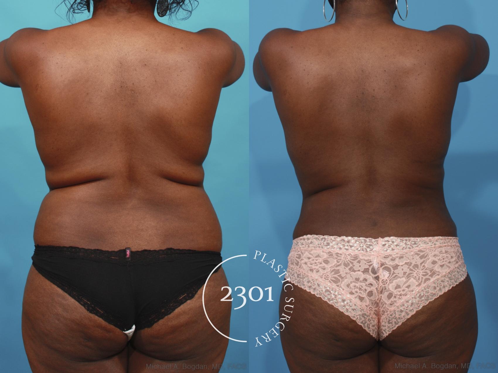 Before & After Mommy Makeover Case 660 Back View in Fort Worth, Plano, & Frisco, Texas