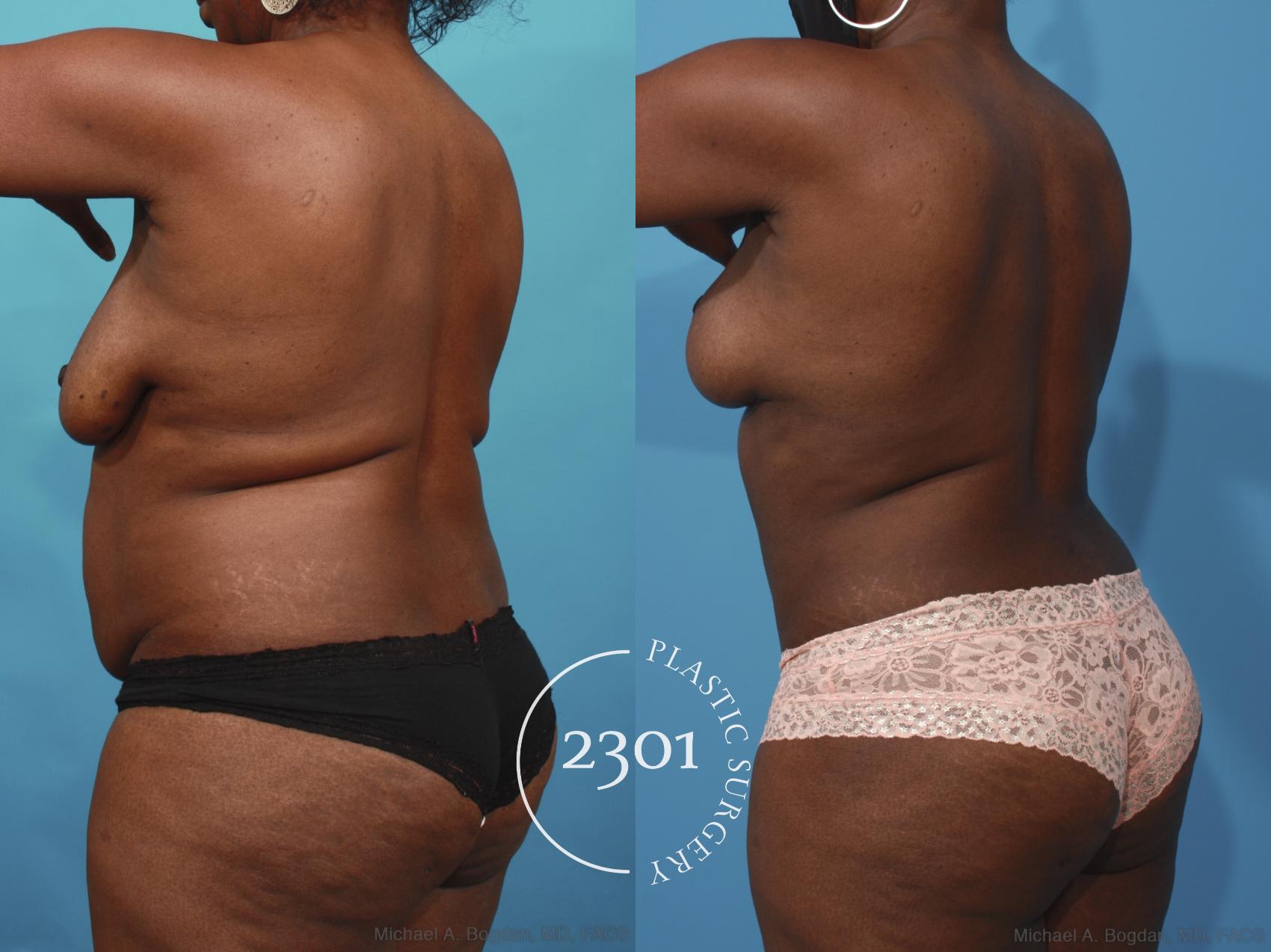 Before & After Mommy Makeover Case 660 Back Left Oblique View in Fort Worth, Plano, & Frisco, Texas