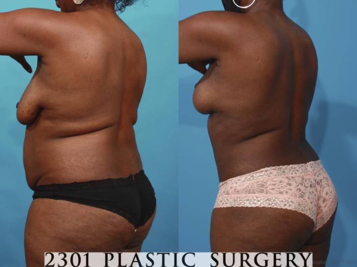 Before & After Mommy Makeover Case 660 Back Left Oblique View in Fort Worth, Plano, & Frisco, Texas