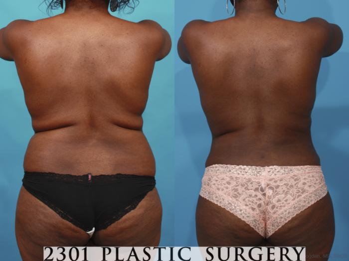 Before & After Mommy Makeover Case 660 Back View in Fort Worth, Plano, & Frisco, Texas