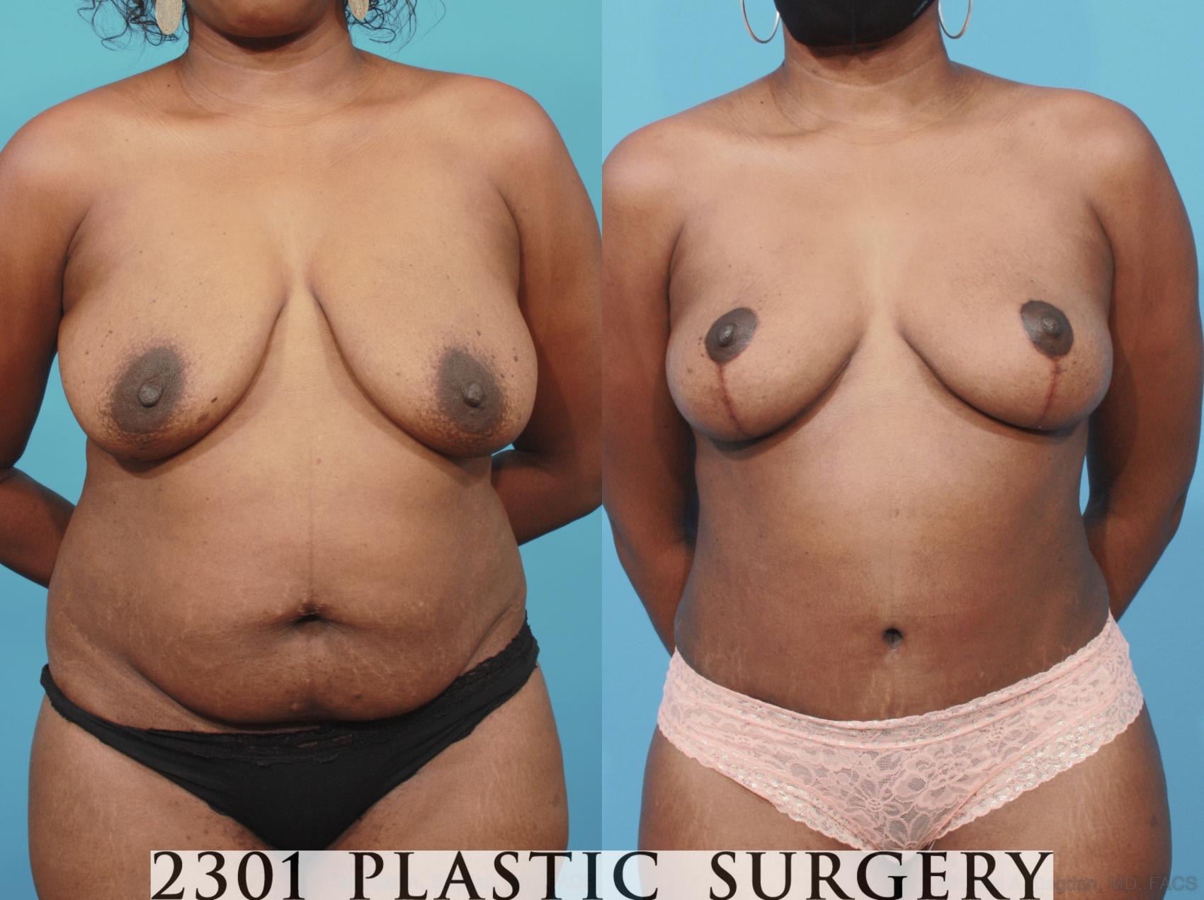 Before & After Mommy Makeover Case 660 Front View in Fort Worth, Plano, & Frisco, Texas