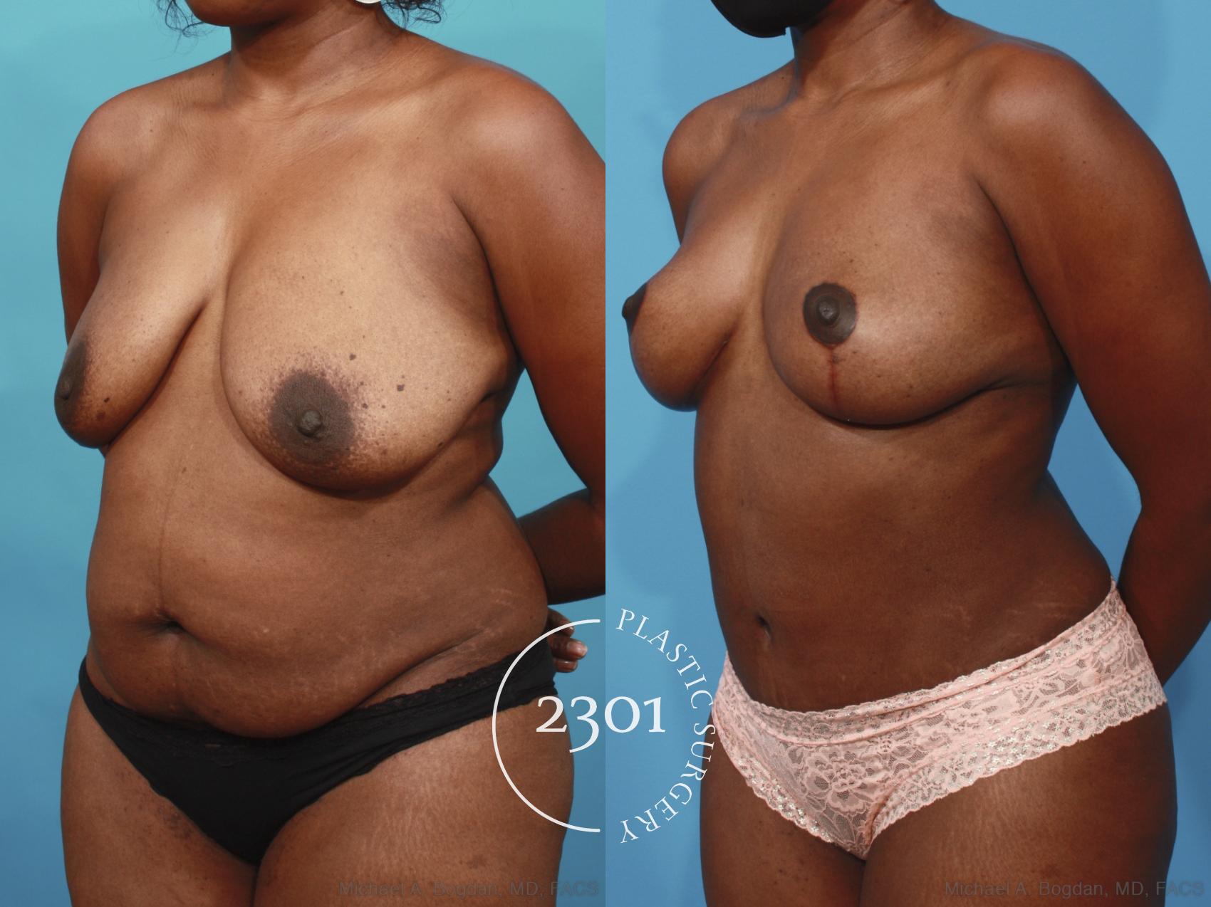Before & After Mommy Makeover Case 660 Left Oblique View in Fort Worth, Plano, & Frisco, Texas