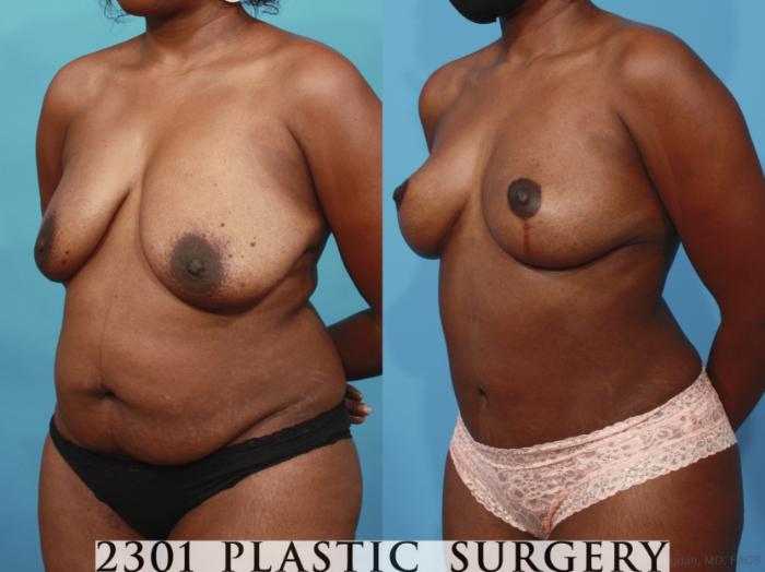 Before & After Breast Lift (Mastopexy) Case 660 Left Oblique View in Fort Worth, Plano, & Frisco, Texas
