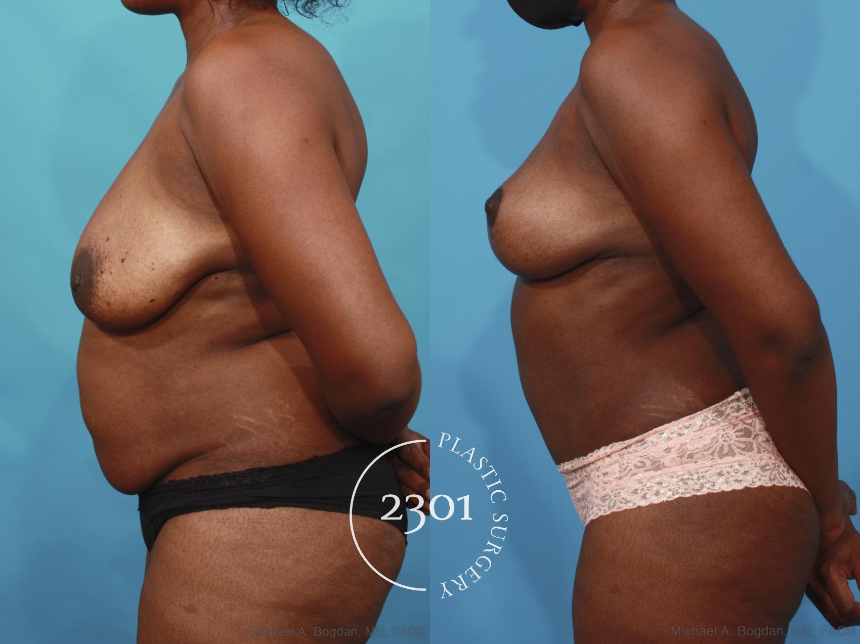 Before & After Mommy Makeover Case 660 Left Side View in Fort Worth, Plano, & Frisco, Texas