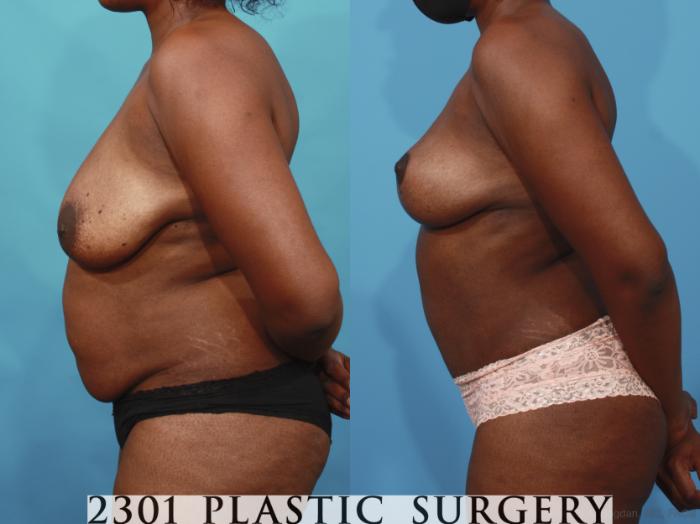 Before & After Mommy Makeover Case 660 Left Side View in Fort Worth, Plano, & Frisco, Texas