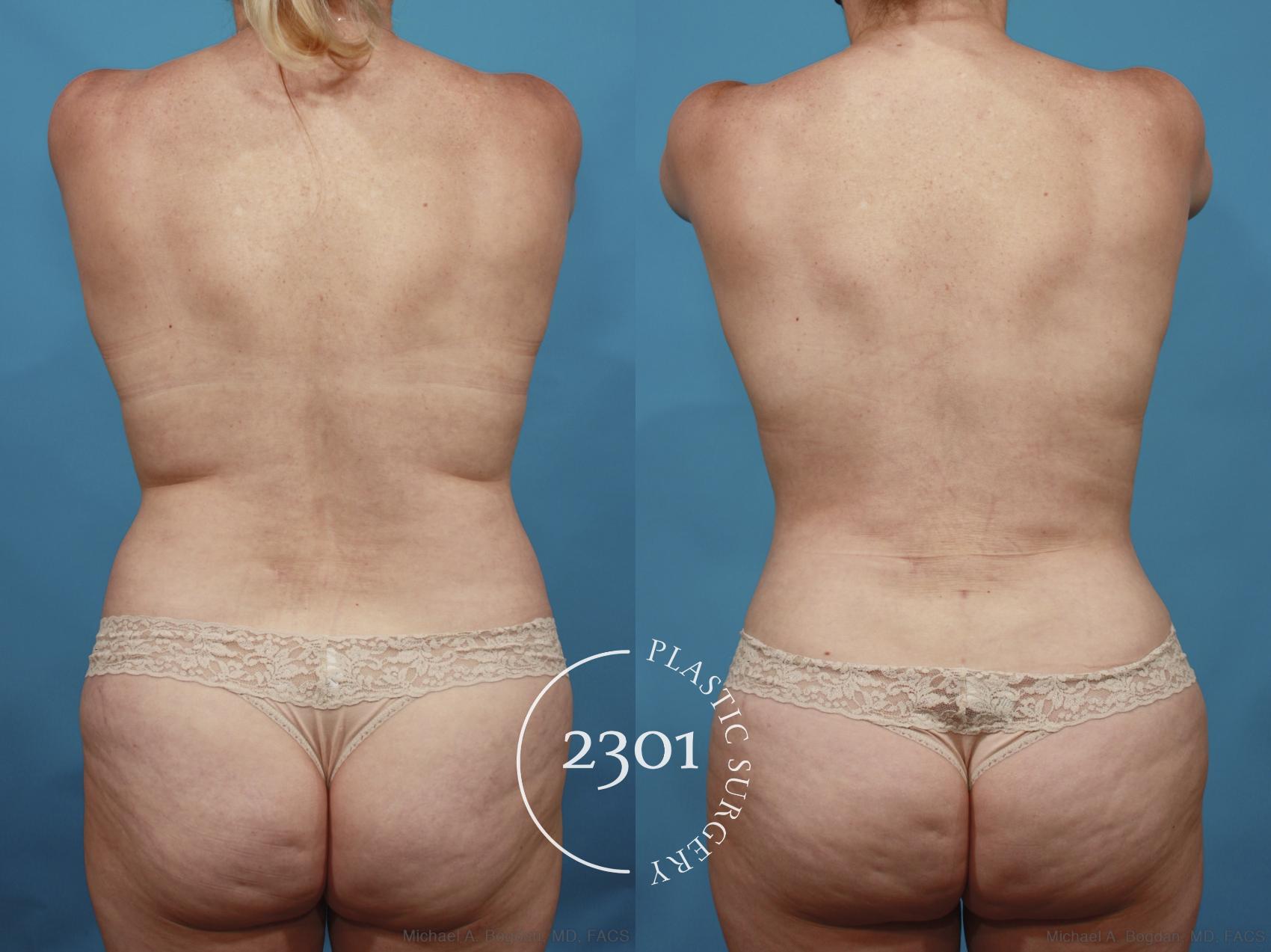 Before & After Tummy Tuck Case 661 Back View in Fort Worth, Plano, & Frisco, Texas