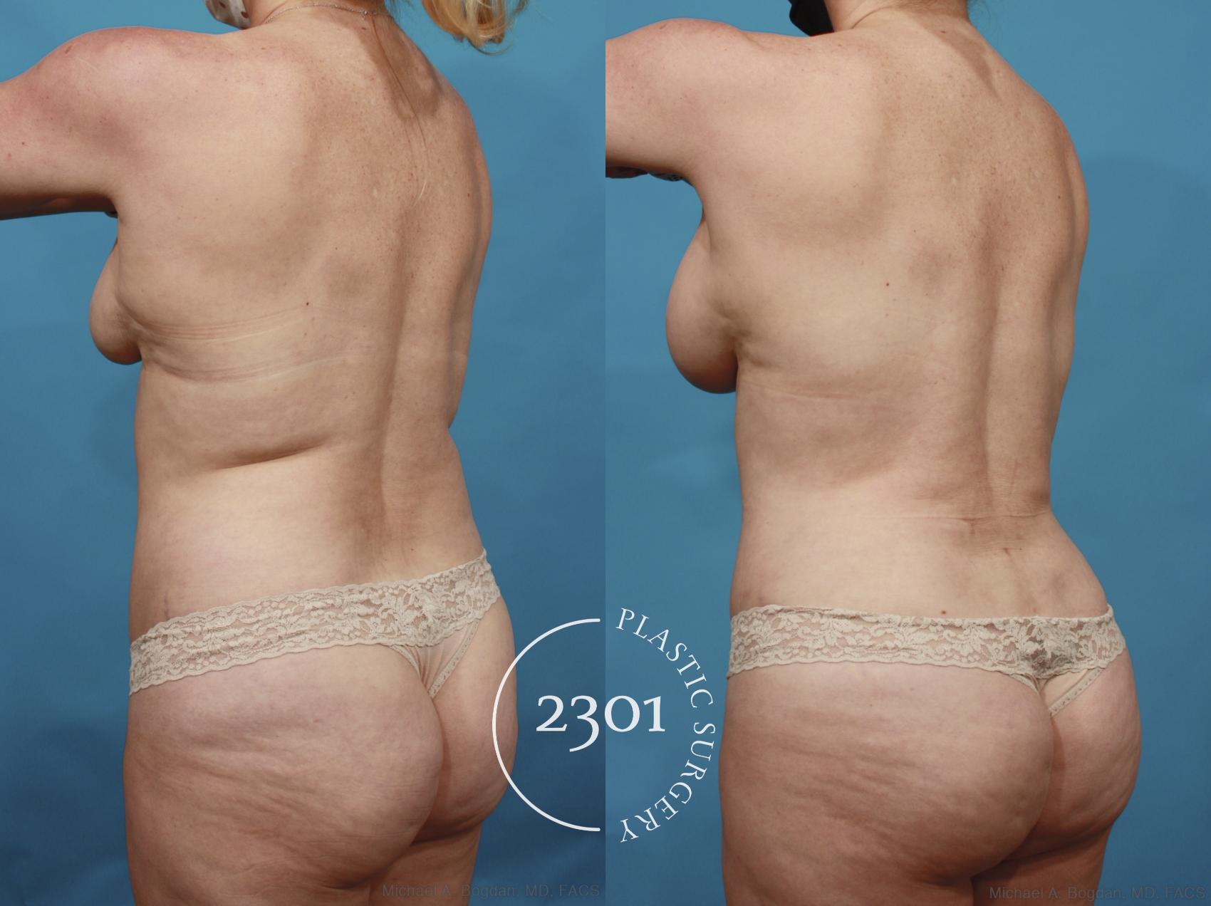 Before & After Tummy Tuck Case 661 Back Left Oblique View in Fort Worth, Plano, & Frisco, Texas