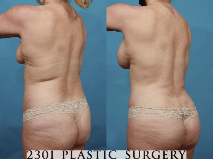 Before & After Silicone Implants Case 661 Back Left Oblique View in Fort Worth, Plano, & Frisco, Texas