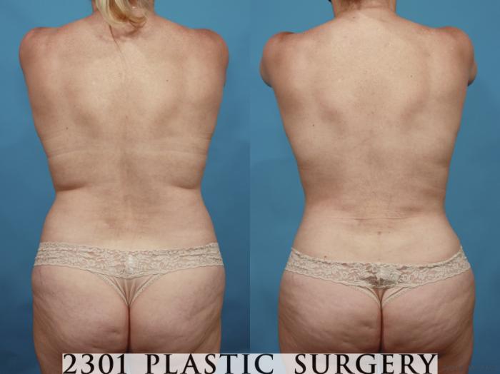 Before & After Silicone Implants Case 661 Back View in Fort Worth, Plano, & Frisco, Texas