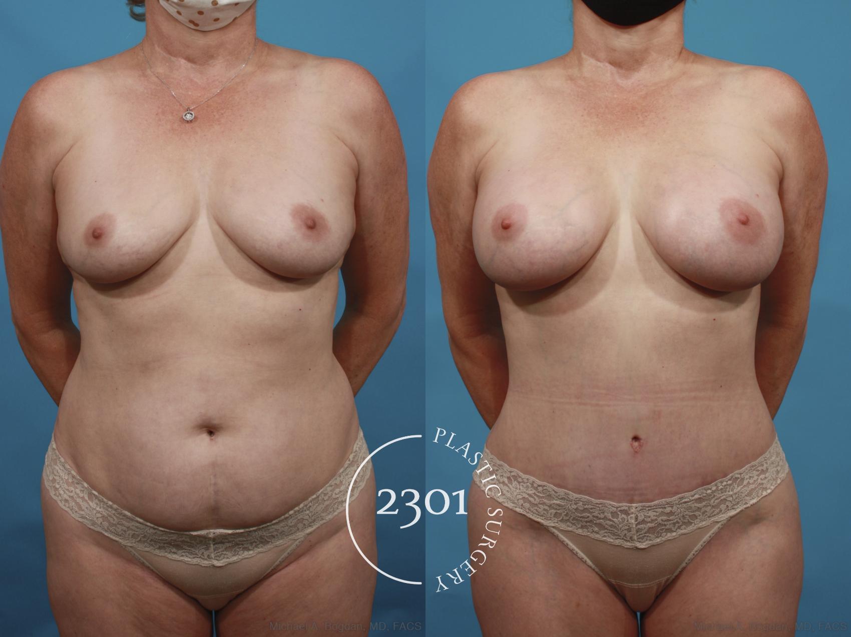 Before & After Tummy Tuck Case 661 Front View in Fort Worth, Plano, & Frisco, Texas