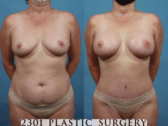 Before & After Tummy Tuck Case 661 Front View in Fort Worth, Plano, & Frisco, Texas