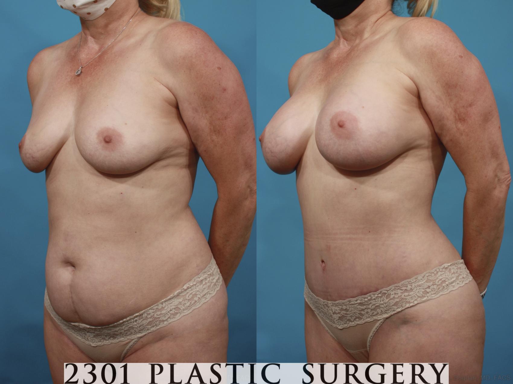 Before & After Silicone Implants Case 661 Left Oblique View in Fort Worth, Plano, & Frisco, Texas