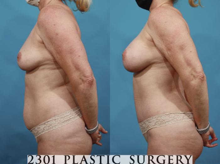Before & After Silicone Implants Case 661 Left Side View in Fort Worth, Plano, & Frisco, Texas