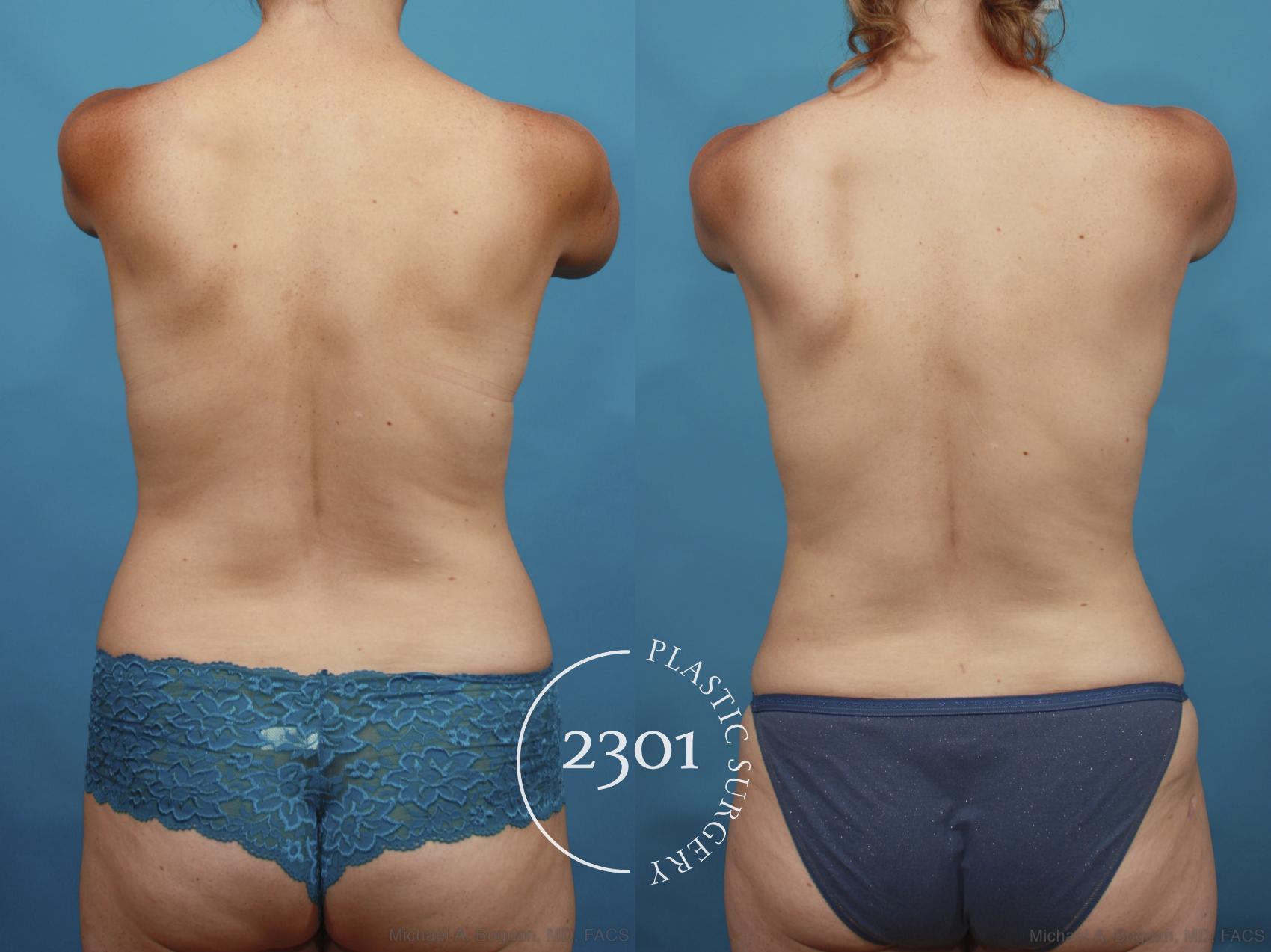 Before & After Mommy Makeover Case 662 Back View in Fort Worth, Plano, & Frisco, Texas
