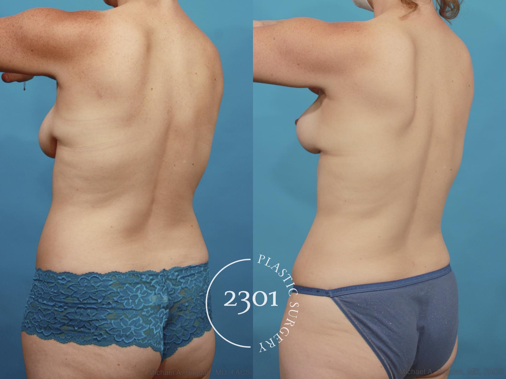 Before & After Mommy Makeover Case 662 Back Left Oblique View in Fort Worth, Plano, & Frisco, Texas