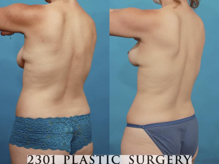 Before & After Mommy Makeover Case 662 Back Left Oblique View in Fort Worth & Frisco, Texas