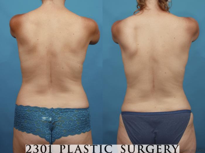 Before & After Mommy Makeover Case 662 Back View in Fort Worth & Frisco, Texas