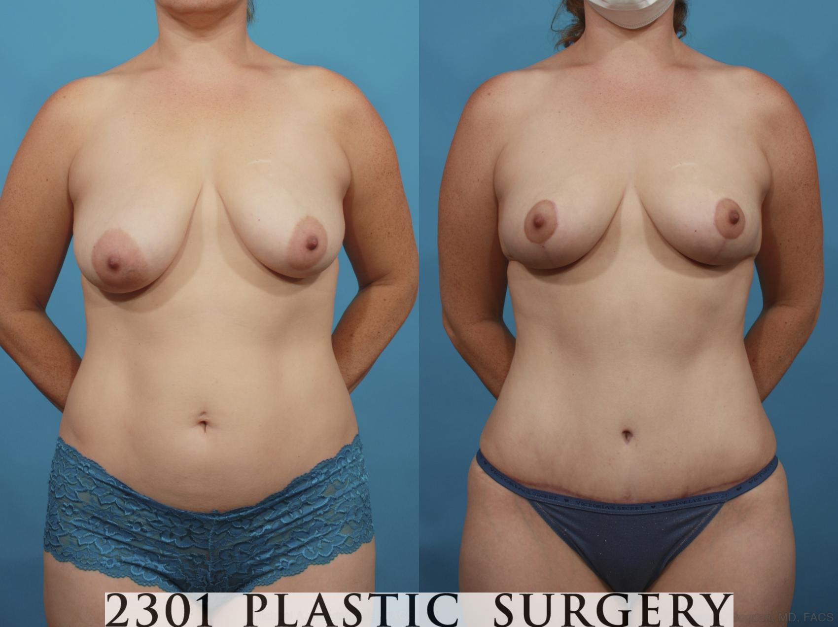 Before & After Mommy Makeover Case 662 Front View in Fort Worth & Frisco, Texas