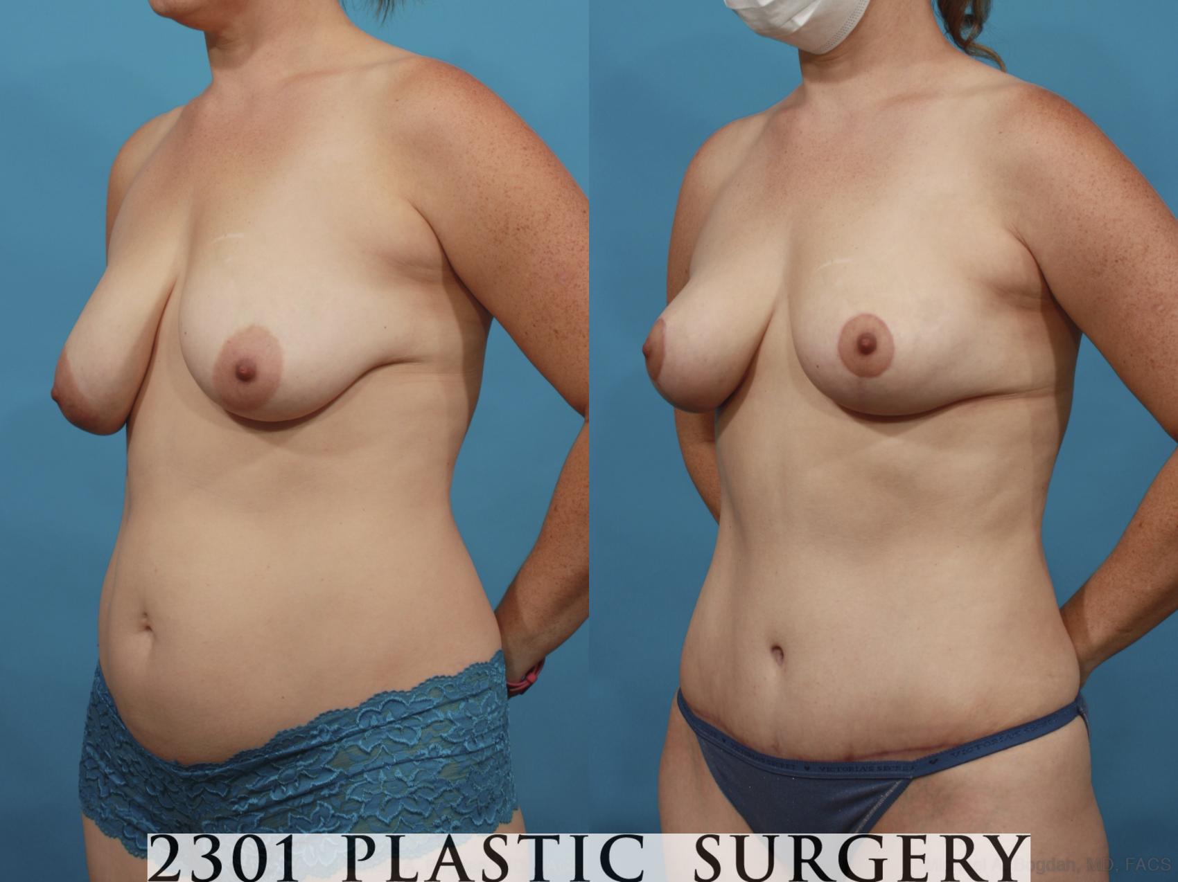 Before & After Mommy Makeover Case 662 Left Oblique View in Fort Worth & Frisco, Texas