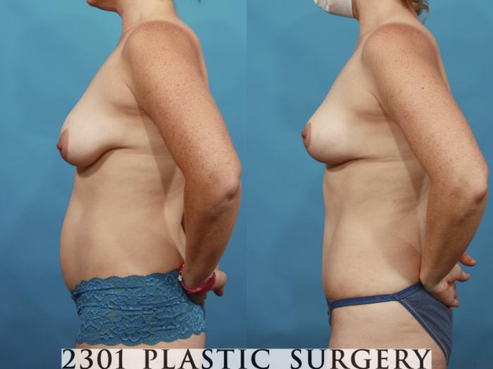Before & After Mommy Makeover Case 662 Left Side View in Fort Worth & Frisco, Texas