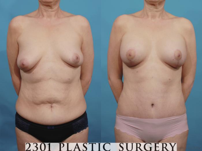 Before & After Silicone Implants Case 663 Front View in Fort Worth, Plano, & Frisco, Texas
