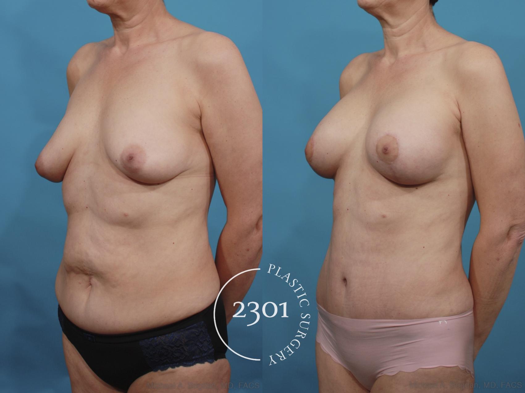 Before & After Silicone Implants Case 663 Left Oblique View in Fort Worth, Plano, & Frisco, Texas